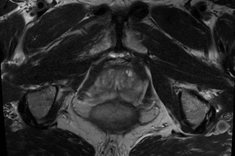 MRI Shaffer