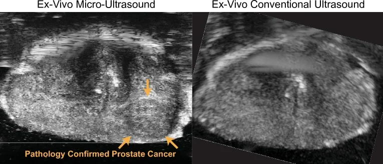 Ultrasounds of Pathology Confirmed Prostate Cancer